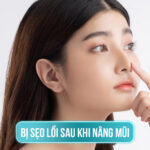 Nguyên nhân bị sẹo lồi sau khi nâng mũi và cách cải thiện
