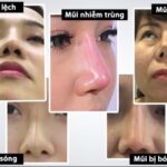 Biến chứng của việc nâng mũi và tất tần tật những điều nhất định phải biết