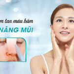 Cách làm tan máu bầm sau nâng mũi hiệu quả nhất