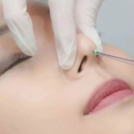 Biến chứng nâng mũi bằng chỉ - Đừng bỏ lỡ giải pháp thẩm mỹ an toàn