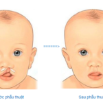 Giải đáp 10 thắc mắc thường gặp về bệnh sứt môi hở hàm ếch
