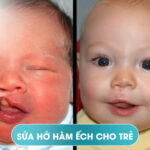 Những điều quan trọng cần biết về sứt môi và hở hàm ếch