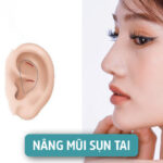 Cách nâng mũi bằng sụn tai - Hỏi đáp về nâng mũi bọc sụn