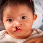 Nguyên nhân sứt môi hở hàm ếch 2 bên - Triệu chứng và giải pháp can thiệp cải thiện