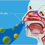 Bị viêm mũi dị ứng có nâng mũi được không? Giải pháp thẩm mỹ an toàn