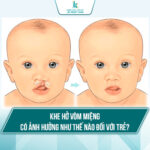 Khe hở vòm miệng có ảnh hưởng như thế nào đối với trẻ?