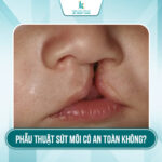 Phẫu thuật sứt môi có an toàn không? Cần nghỉ dưỡng như thế nào sau phẫu thuật? 