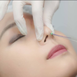 Căng chỉ nâng mũi - Nhất định phải biết sự thật này nếu muốn làm đẹp