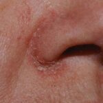 Những điều cần biết về cắt chỉ nâng mũi