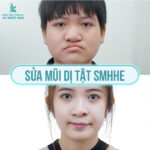 Sửa mũi SMHHE - 5 đặc quyền chỉ có tại BV JK Nhật Hàn